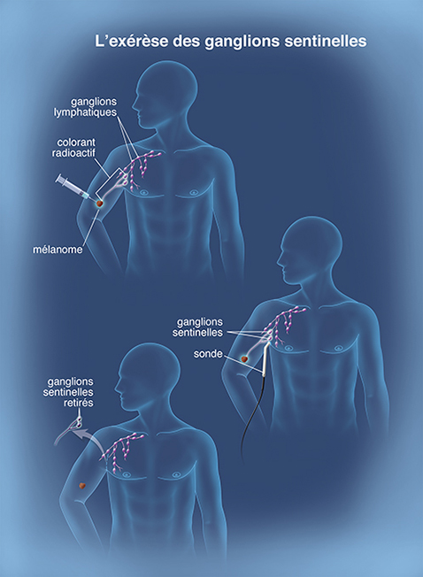 Exérèse ganglion sentinelle